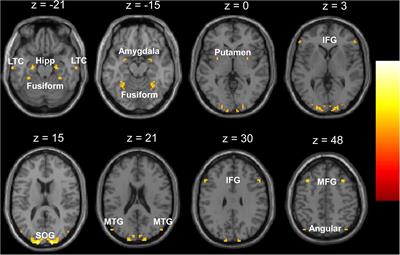 Impaired Functional Homotopy and Topological Properties Within the Default Mode Network of Children With Generalized Tonic-Clonic Seizures: A Resting-State fMRI Study